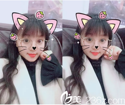 在深圳美萊找陳磊做完雙眼皮兩個月圖片 在深圳美萊找陳磊做完雙眼皮兩個月圖片