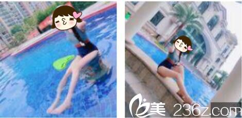 對比韓國DIMARE和原辰醫(yī)院吸脂案例，我找李夏榮做了腰腹吸脂