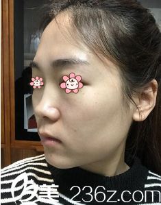 術(shù)前我的鼻子特別塌 術(shù)前我的鼻子特別塌