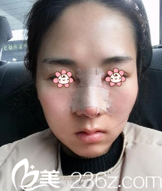 術(shù)后三天的樣子 術(shù)后三天的樣子