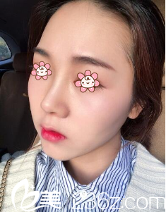 鄭鎬勛假體隆鼻術(shù)后11天 鄭鎬勛假體隆鼻術(shù)后11天