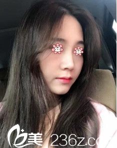 韓國I LOVE整形外科鄭鎬勛假體隆鼻術(shù)后一個(gè)月 韓國I LOVE整形外科鄭鎬勛假體隆鼻術(shù)后一個(gè)月