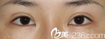在金華時(shí)光做雙眼皮修復(fù)前 在金華時(shí)光做雙眼皮修復(fù)前