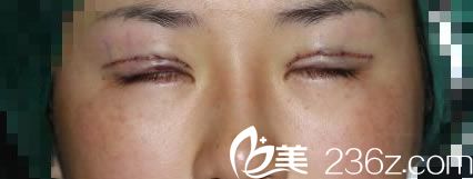 金華時(shí)光剛做完雙眼皮修復(fù)圖片 金華時(shí)光剛做完雙眼皮修復(fù)圖片
