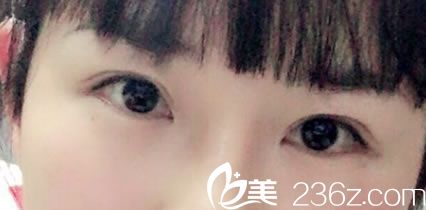 為了讓大家變美路上少走彎路,現(xiàn)分享我在金華時(shí)光做雙眼皮失敗修復(fù)恢復(fù)日記