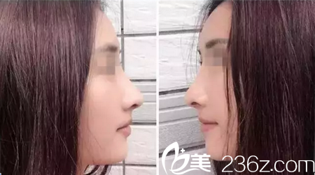 一直糾結于和大慶彤名哪家做鼻子好？終于還是在閨蜜的介紹下選擇了彤名整形醫(yī)院王儷娟院長做鼻綜合，分享我手術15天后的效果