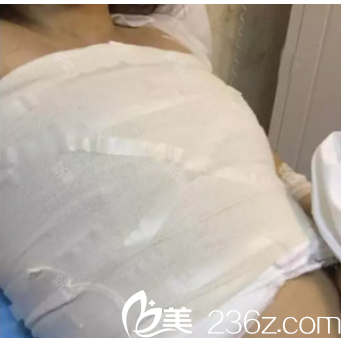 在廣州海峽做完隆胸術(shù)后天 在廣州海峽做完隆胸術(shù)后天