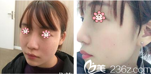 林秉州院長隆鼻修復(fù)案例