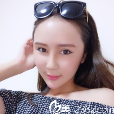 鼻綜合隆鼻和自體脂肪填充9天恢復(fù)<span style=