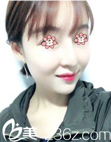 次假體隆鼻失敗了這回來(lái)韓國(guó)I WANT整形外科林秉州這兒做鼻綜合修復(fù)。