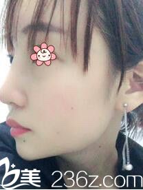 韓國I WANT整形外科林秉州鼻修復術(shù)后25天 韓國I WANT整形外科林秉州鼻修復術(shù)后25天