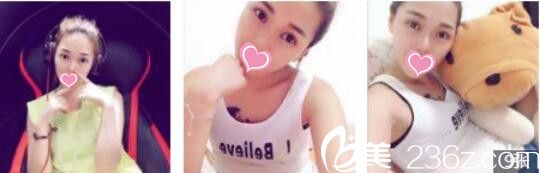 韓國Bone整形外科劉永俊切開法雙眼皮真人案例術(shù)后一個月 韓國Bone整形外科劉永俊切開法雙眼皮真人案例術(shù)后一個月