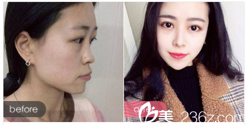 深圳富華整形醫(yī)院做的隆鼻案例圖 深圳富華整形醫(yī)院做的隆鼻案例圖