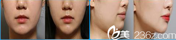 金永薰院長面部輪廓整形效果案例 金永薰院長面部輪廓整形效果案例