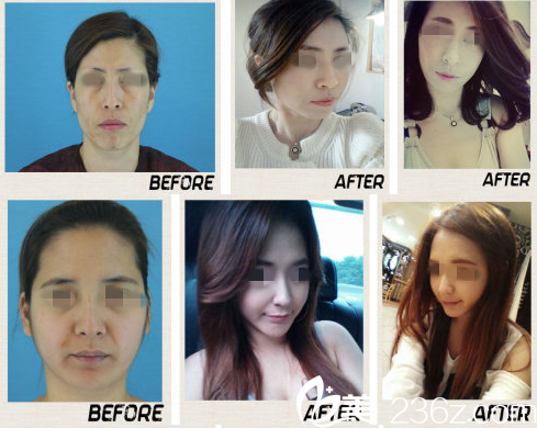 童顏整形前后對比圖