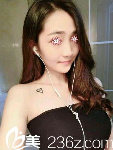 楊東運(yùn)自體脂肪隆胸術(shù)后20天 楊東運(yùn)自體脂肪隆胸術(shù)后20天