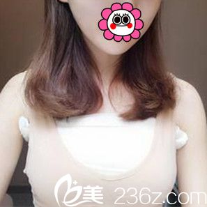 假體隆胸術后3天效果