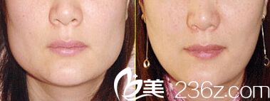 咬肌去除術(shù)對比案例 咬肌去除術(shù)對比案例