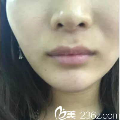 在北京美萊注射豐唇前樣子 在北京美萊注射豐唇前樣子