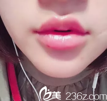 在北京美萊玻尿酸注射豐嘟嘟唇第8天效果 在北京美萊玻尿酸注射豐嘟嘟唇第8天效果