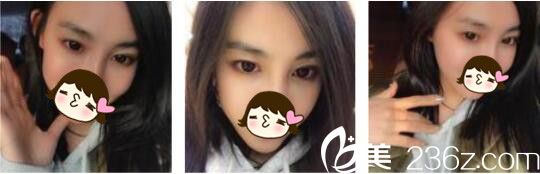 韓國Bozar毛發(fā)種植技術(shù)好不好？看半年前我去做的發(fā)際線種植術(shù)后效果圖