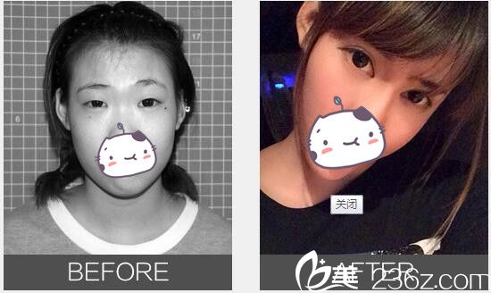 單眼皮、上瞼臃腫、雙眼無神在無錫麗都做雙眼皮