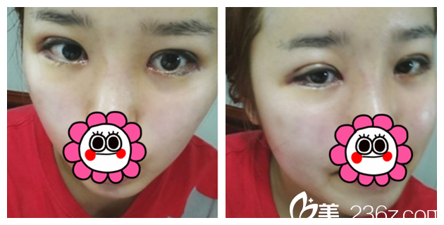 術(shù)后一周拆線雙眼皮恢復(fù)