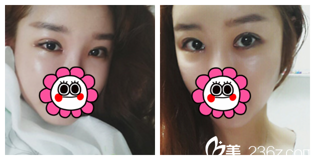 半個月后雙眼皮恢復(fù)