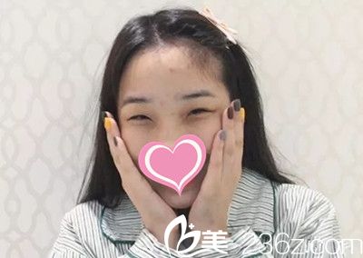 雙眼皮手術(shù)前照片 雙眼皮手術(shù)前照片