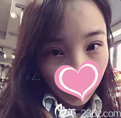 雙眼皮 拆線了 雙眼皮 拆線了