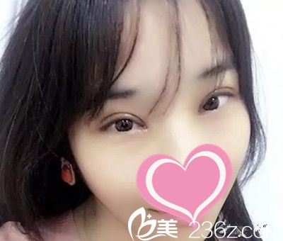 許言午雙眼皮手術(shù)案例 許言午雙眼皮手術(shù)案例