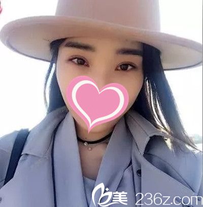 過年在九江臺美做了雙眼皮手術(shù)，算是擺脫了瞇瞇眼