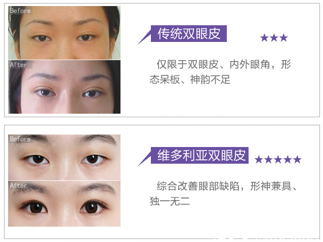 在南京維多利亞做雙眼皮案例