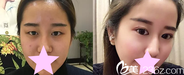 全切雙眼皮案例前后對比圖