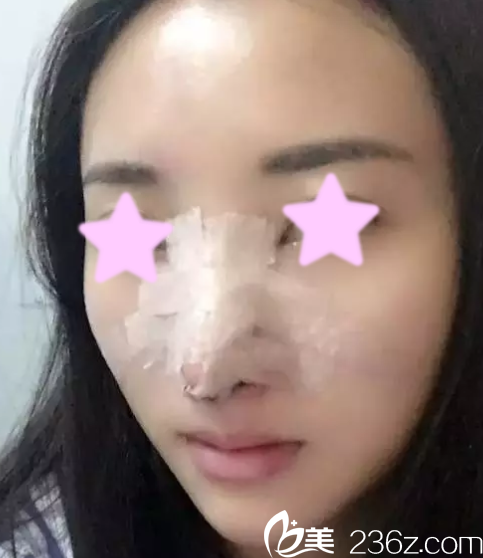 我在大同清木做自體肋骨隆鼻后第5天照片