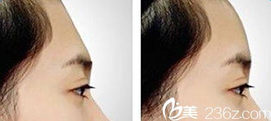 額頭填充代表案例