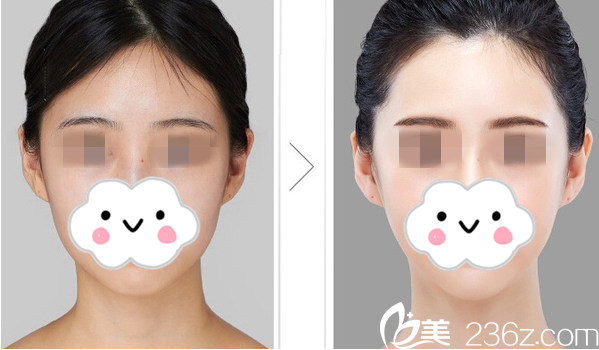 下巴整形前后對比效果