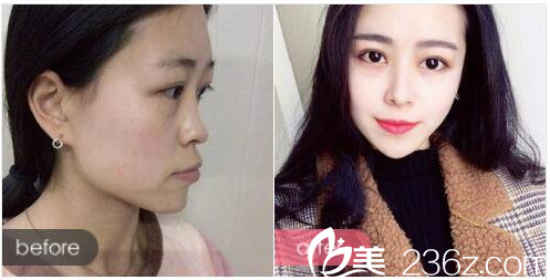 廣州曙光張元龍醫(yī)生做的隆鼻案例 廣州曙光張元龍醫(yī)生做的隆鼻案例