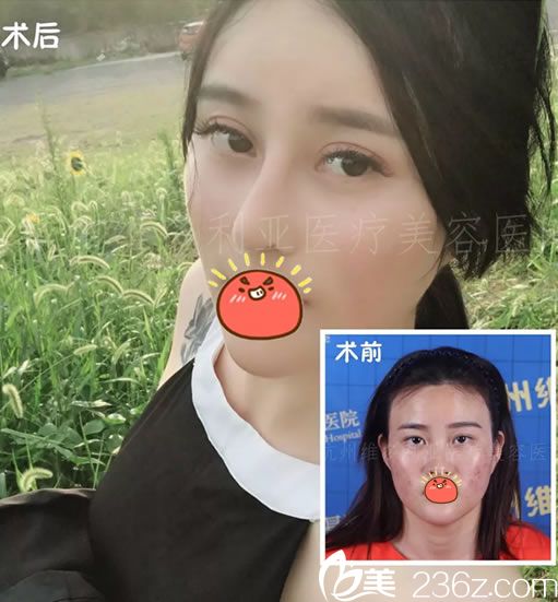 杭州維多利亞周長(zhǎng)兵雙眼皮和隆鼻案例