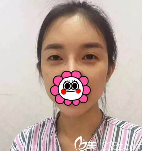 在北京壹加壹做眼修復(fù)前樣子 在北京壹加壹做眼修復(fù)前樣子