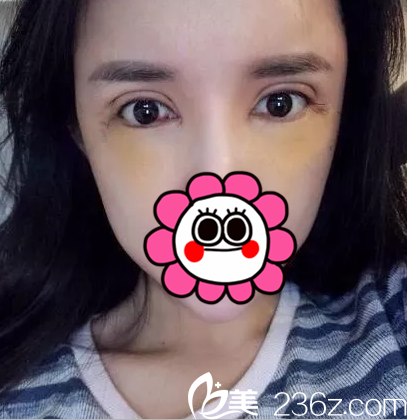 在北京壹加壹做眼修復(fù)第6天效果 在北京壹加壹做眼修復(fù)第6天效果