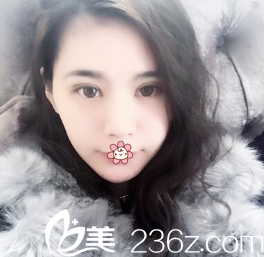 任在浩雙眼皮加開(kāi)眼角術(shù)后半個(gè)月 任在浩雙眼皮加開(kāi)眼角術(shù)后半個(gè)月