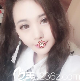 韓國(guó)i-Line整形外科雙眼皮術(shù)后39天 韓國(guó)i-Line整形外科雙眼皮術(shù)后39天