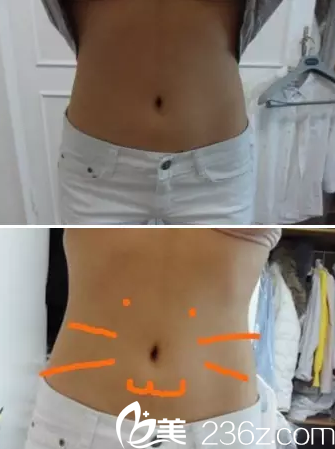 大同清木整形怎么樣？爆料我做腰腹部360水動力吸脂真實經歷及20天恢復效果圖