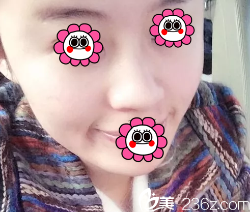 在北京米揚(yáng)麗格做鼻修復(fù)前樣子 在北京米揚(yáng)麗格做鼻修復(fù)前樣子