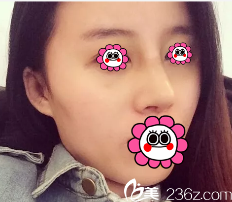 在北京米揚(yáng)麗格做鼻修復(fù)第9天效果 在北京米揚(yáng)麗格做鼻修復(fù)第9天效果