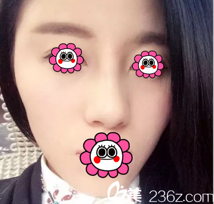 在北京米揚(yáng)麗格找巫文云做鼻修復(fù)第16天效果 在北京米揚(yáng)麗格找巫文云做鼻修復(fù)第16天效果