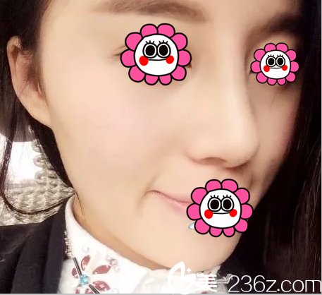 歪鼻多年終于讓我在北京米揚(yáng)麗格釋?xiě)堰x擇巫文云修復(fù)因發(fā)小隆鼻效果好