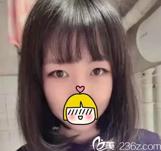 在北京米蘭柏羽麗都做雙眼皮前樣子 在北京米蘭柏羽麗都做雙眼皮前樣子