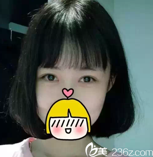 北京米蘭柏羽麗都切開雙眼皮案例 北京米蘭柏羽麗都切開雙眼皮案例